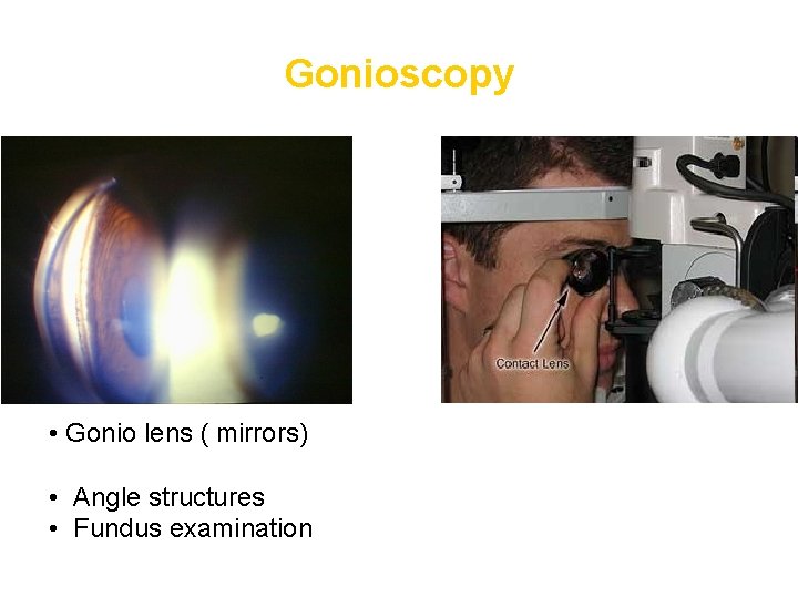 Gonioscopy • Gonio lens ( mirrors) • Angle structures • Fundus examination 