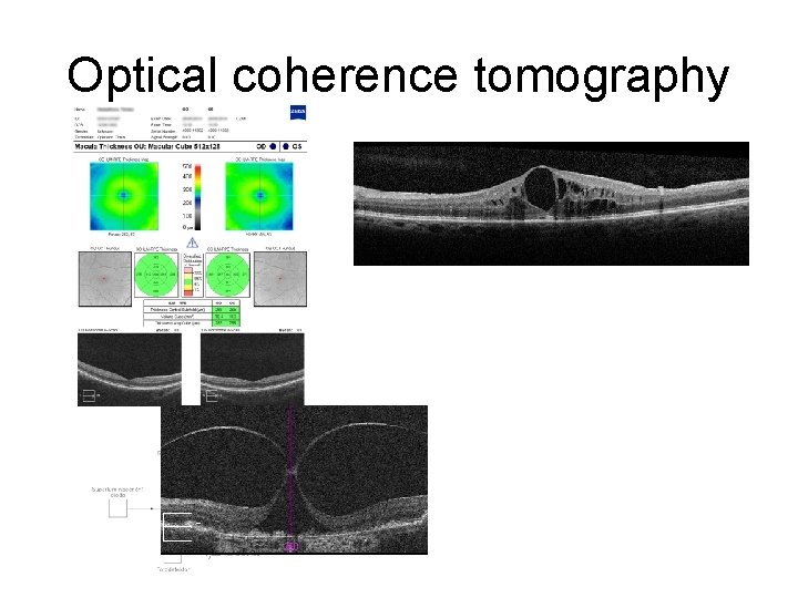 Optical coherence tomography 