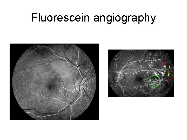 Fluorescein angiography 