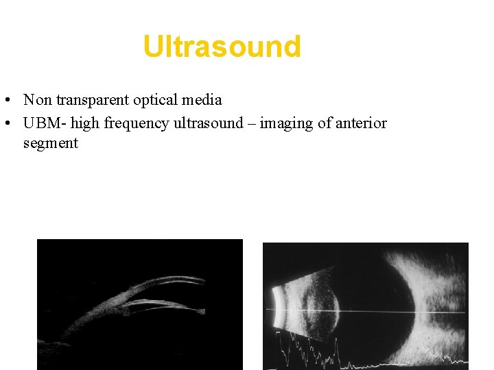 Ultrasound • Non transparent optical media • UBM- high frequency ultrasound – imaging of