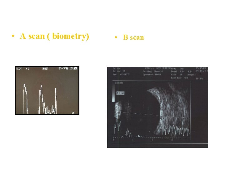  • A scan ( biometry) • B scan 