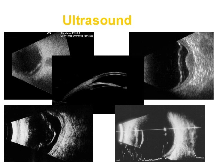 Ultrasound 