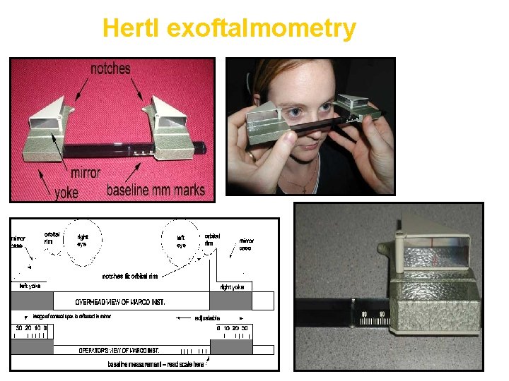 Hertl exoftalmometry 