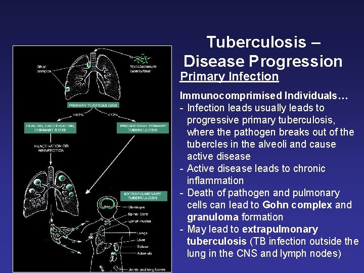 Tuberculosis – Disease Progression Primary Infection Immunocomprimised Individuals… - Infection leads usually leads to