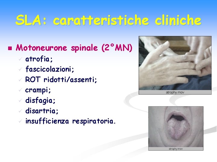 SLA: caratteristiche cliniche n Motoneurone spinale (2°MN) ü ü ü ü atrofia; fascicolazioni; ROT