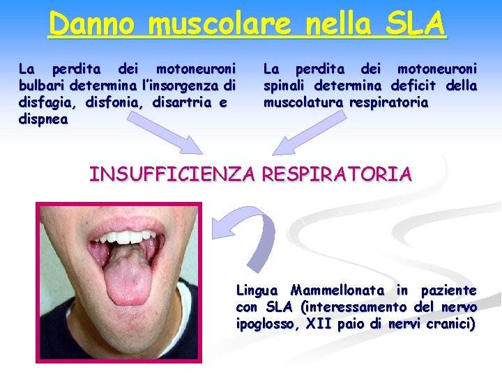 Danno muscolare nella SLA La perdita dei motoneuroni bulbari determina l’insorgenza di disfagia, disfonia,
