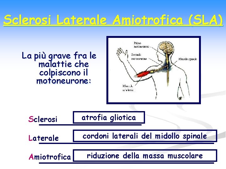 Sclerosi Laterale Amiotrofica (SLA) La più grave fra le malattie che colpiscono il motoneurone: