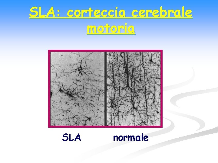 SLA: corteccia cerebrale motoria SLA normale 