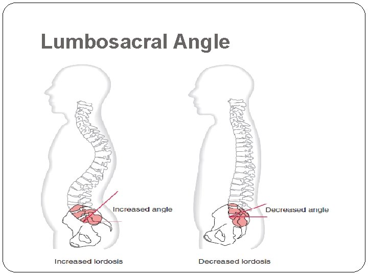 Lumbosacral Angle 