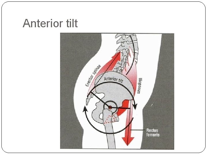 Anterior tilt 