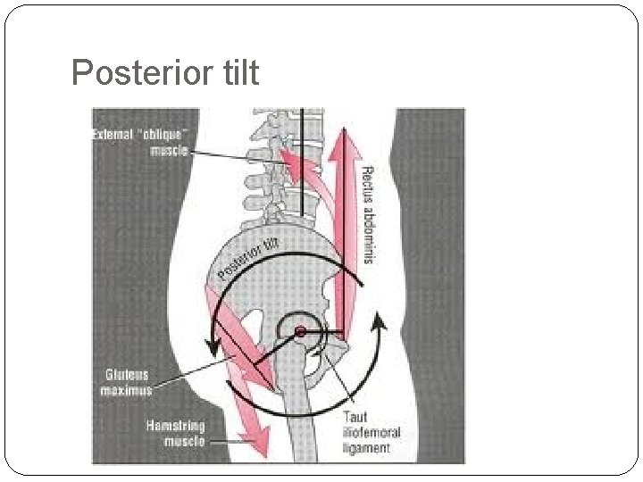 Posterior tilt 