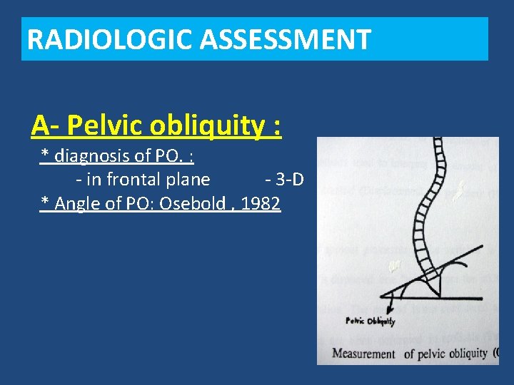 RADIOLOGIC ASSESSMENT A- Pelvic obliquity : * diagnosis of PO. : - in frontal