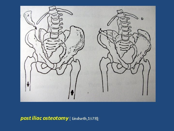 post iliac osteotomy [ Lindseth, 1978]; 