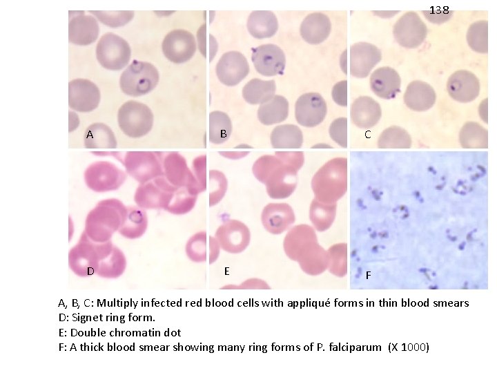 138 A B C D E F A, B, C: Multiply infected red blood