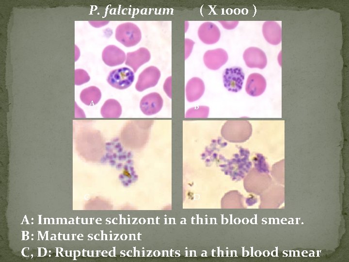 P. falciparum A C ( X 1000 ) B D A: Immature schizont in