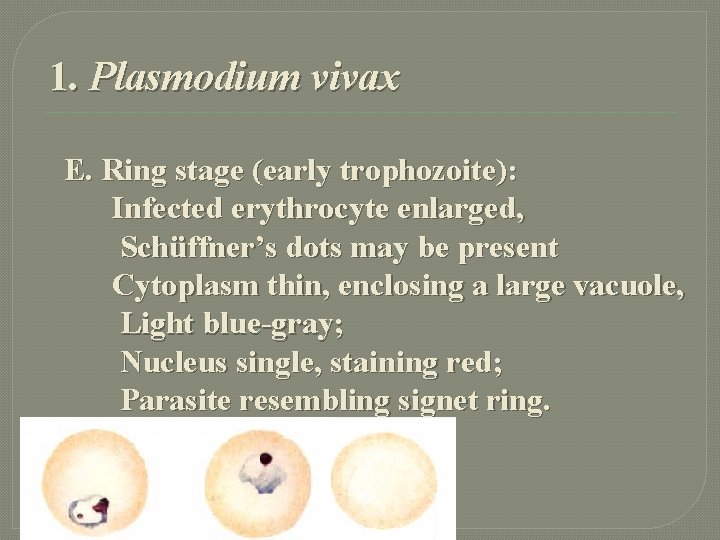 1. Plasmodium vivax E. Ring stage (early trophozoite): Infected erythrocyte enlarged, Schüffner’s dots may