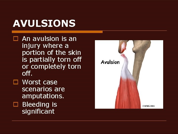 AVULSIONS o An avulsion is an injury where a portion of the skin is
