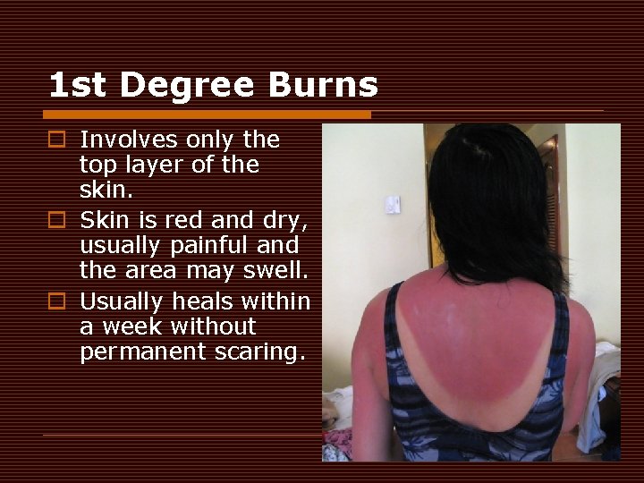 1 st Degree Burns o Involves only the top layer of the skin. o