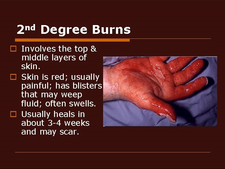 2 nd Degree Burns o Involves the top & middle layers of skin. o