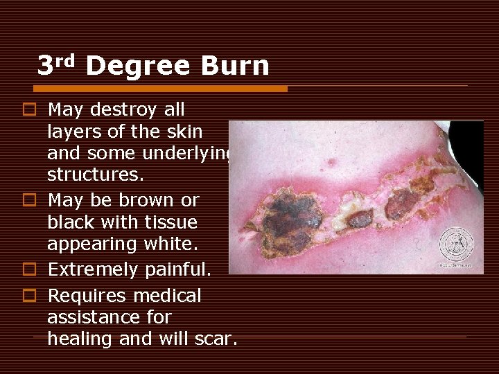 3 rd Degree Burn o May destroy all layers of the skin and some