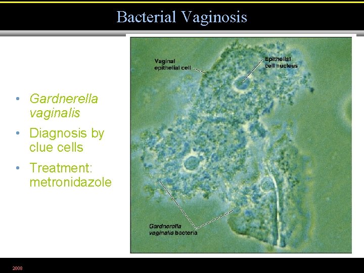 Bacterial Vaginosis • Gardnerella vaginalis • Diagnosis by clue cells • Treatment: metronidazole 2008