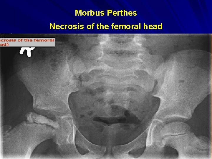 Morbus Perthes Necrosis of the femoral head 