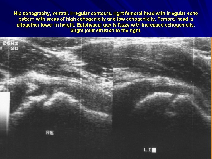 Hip sonography, ventral. Irregular contours, right femoral head with irregular echo pattern with areas