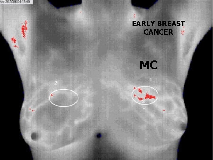 EARLY BREAST CANCER MC 