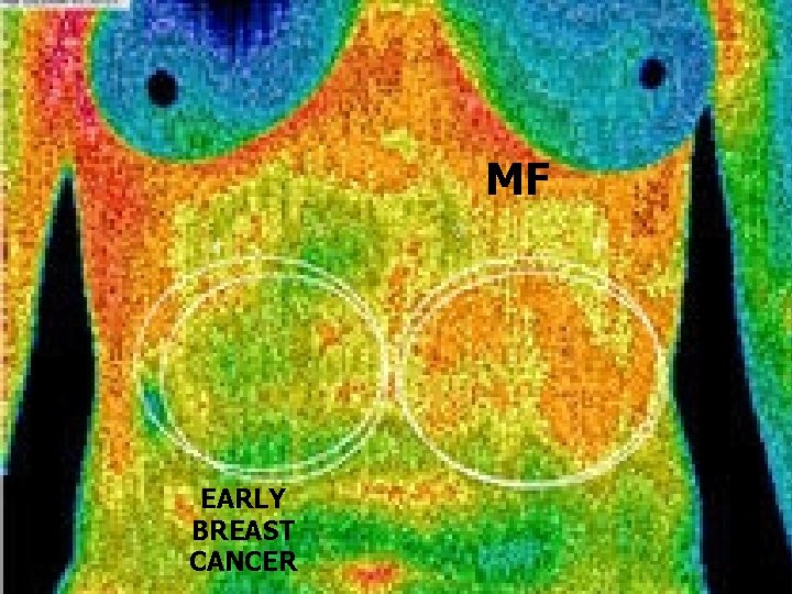 MF EARLY BREAST CANCER 