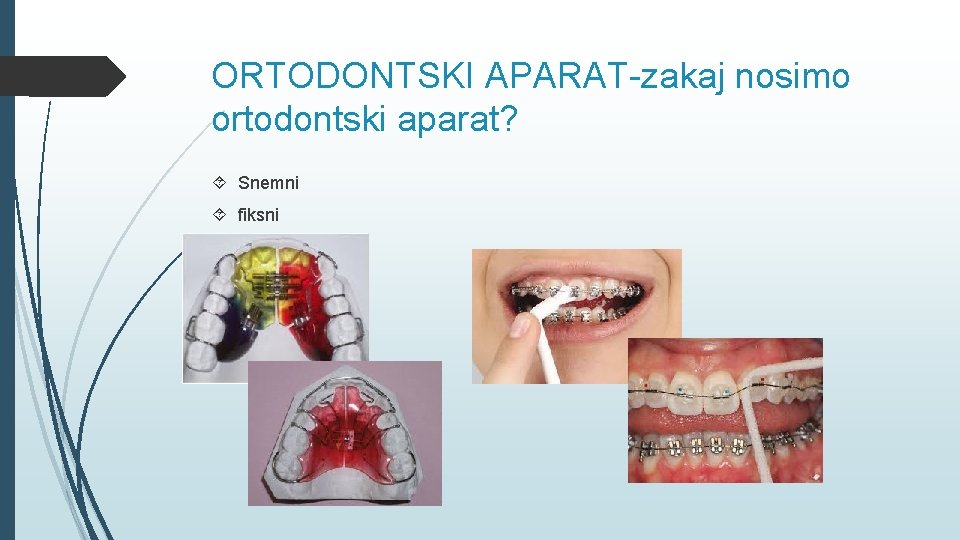 ORTODONTSKI APARAT-zakaj nosimo ortodontski aparat? Snemni fiksni 