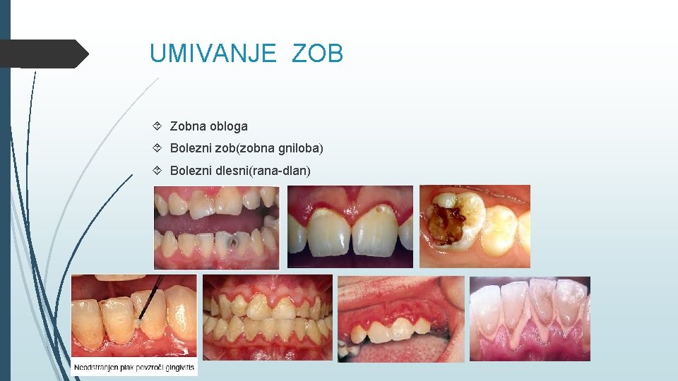 UMIVANJE ZOB Zobna obloga Bolezni zob(zobna gniloba) Bolezni dlesni(rana-dlan) 