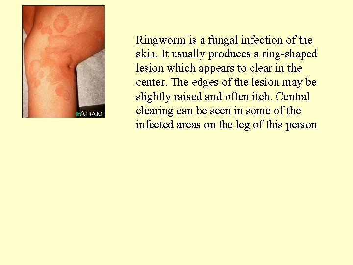 Ringworm is a fungal infection of the skin. It usually produces a ring-shaped lesion