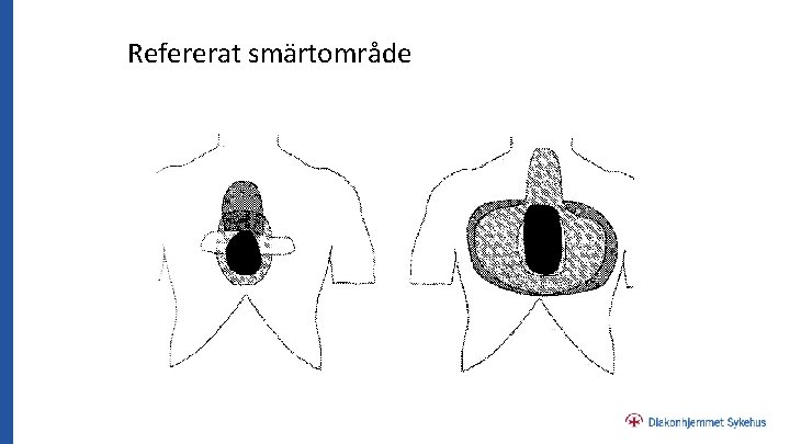 Refererat smärtområde 