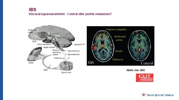 IBS Visceral hypersensitivitet - Central eller perifer mekanism? 