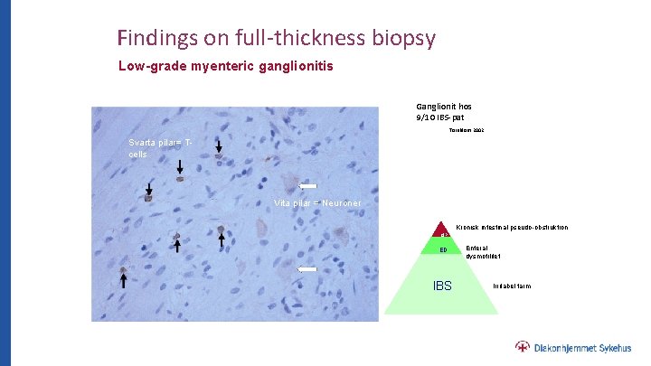 Findings on full-thickness biopsy Low-grade myenteric ganglionitis Ganglionit hos 9/10 IBS-pat Törnblom 2002 Svarta