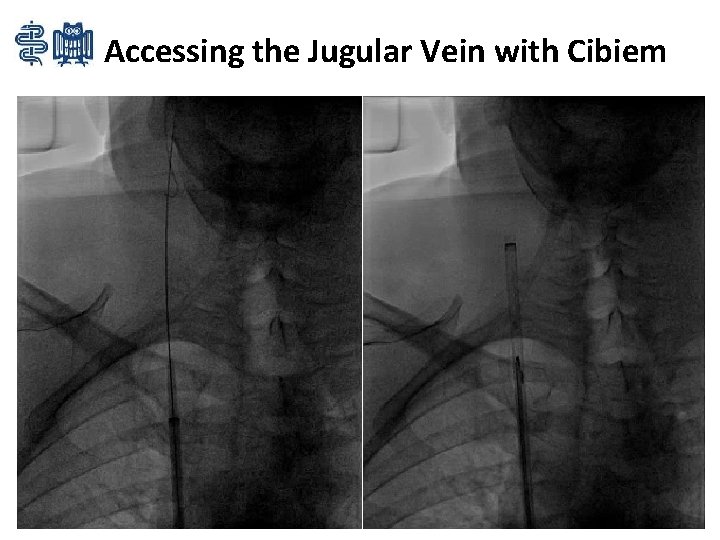 Accessing the Jugular Vein with Cibiem 