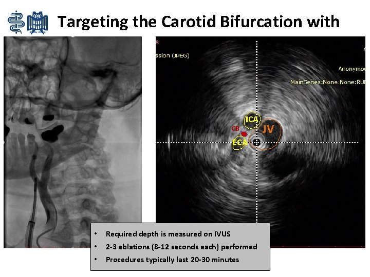 Targeting the Carotid Bifurcation with IVUS CB ICA ECA • Required depth is measured