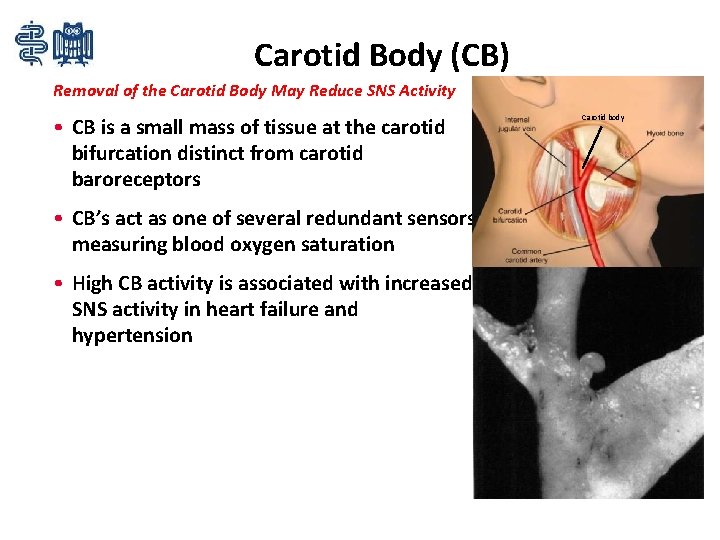 Carotid Body (CB) Removal of the Carotid Body May Reduce SNS Activity • CB