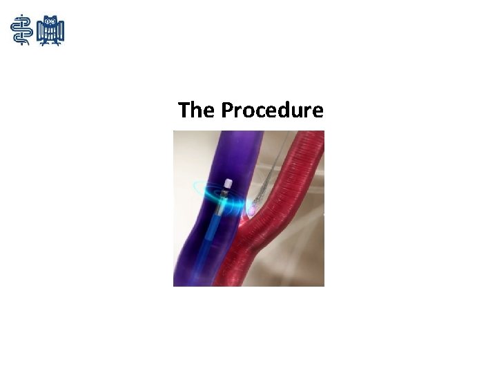 The Procedure 