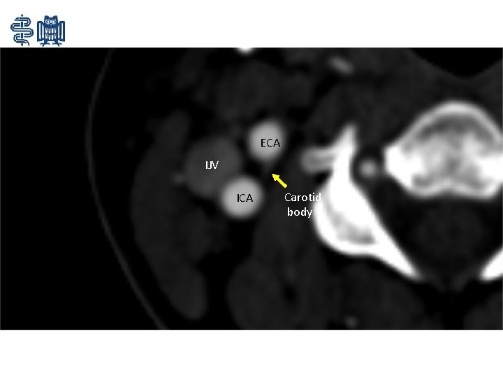 ECA IJV ICA Carotid body 