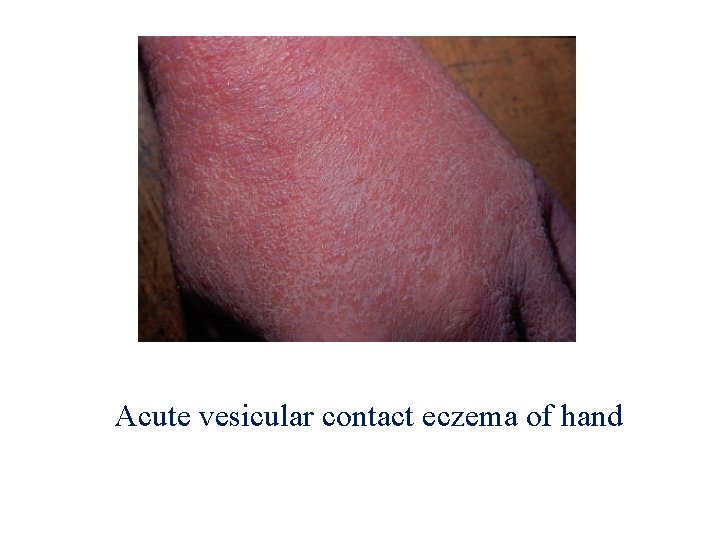 Acute vesicular contact eczema of hand 