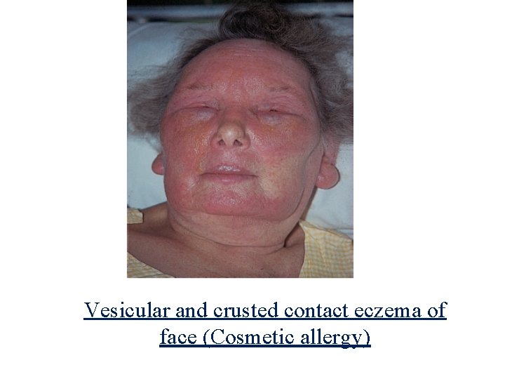 Vesicular and crusted contact eczema of face (Cosmetic allergy) 