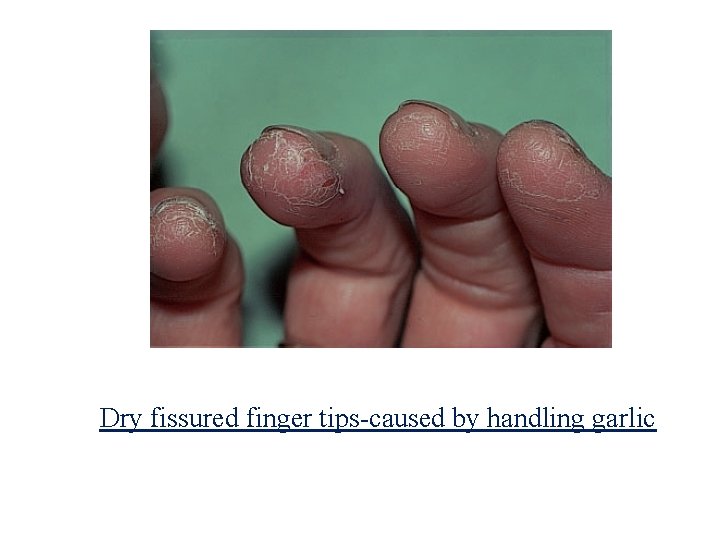 Dry fissured finger tips-caused by handling garlic 