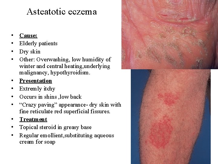 Asteatotic eczema • • • Cause: Elderly patients Dry skin Other: Overwashing, low humidity