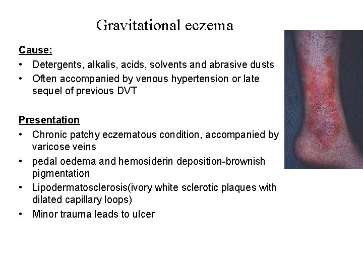 Gravitational eczema Cause: • Detergents, alkalis, acids, solvents and abrasive dusts • Often accompanied