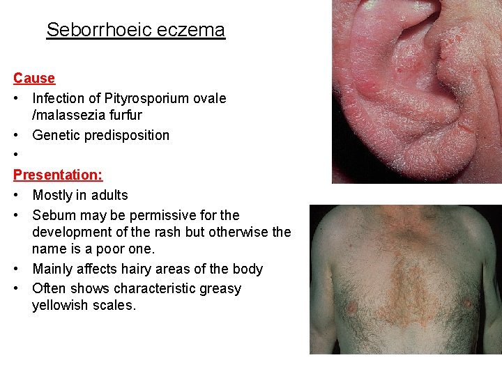 Seborrhoeic eczema Cause • Infection of Pityrosporium ovale /malassezia furfur • Genetic predisposition •