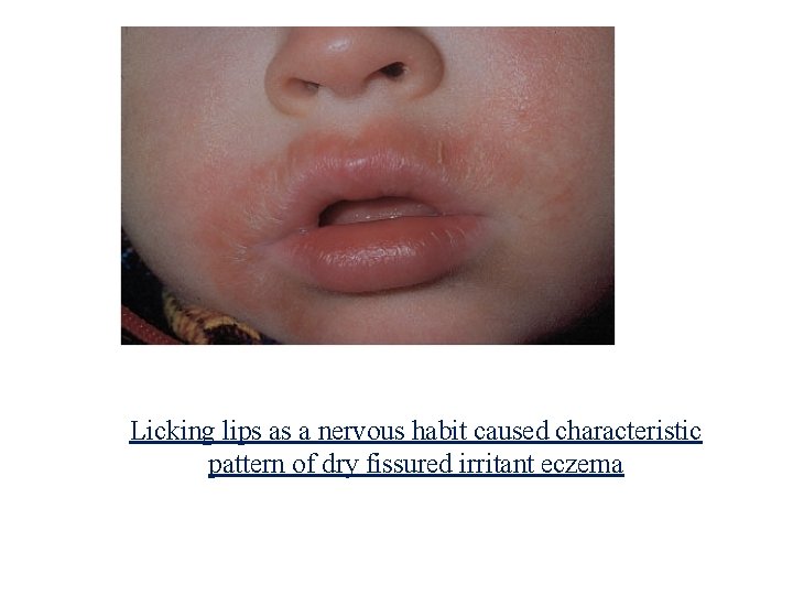 Licking lips as a nervous habit caused characteristic pattern of dry fissured irritant eczema