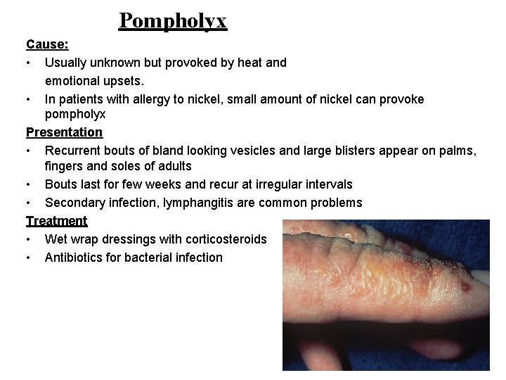 Pompholyx Cause: • Usually unknown but provoked by heat and emotional upsets. • In
