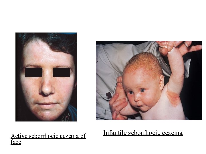 Active seborrhoeic eczema of face Infantile seborrhoeic eczema 
