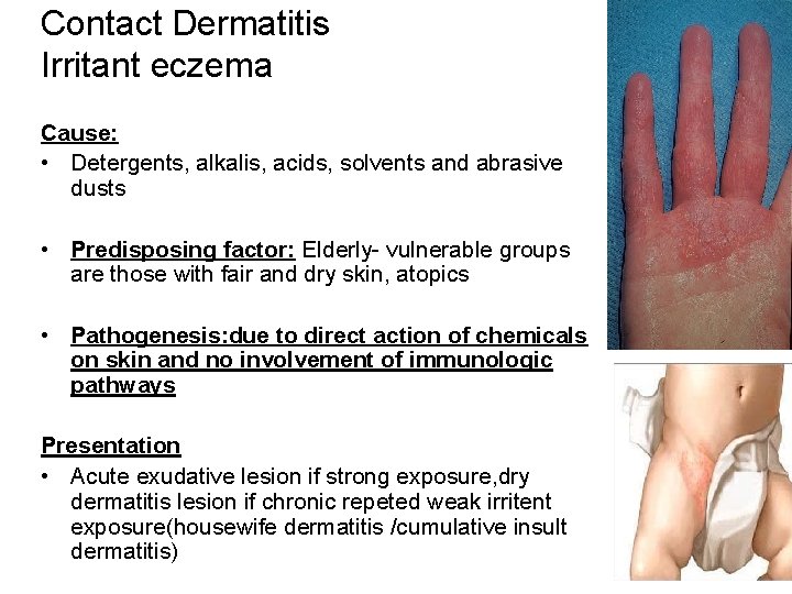 Contact Dermatitis Irritant eczema Cause: • Detergents, alkalis, acids, solvents and abrasive dusts •